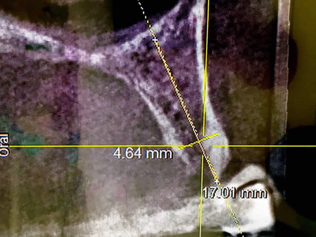 3D Röntgenbild - Berechnung Knochenaufbau
