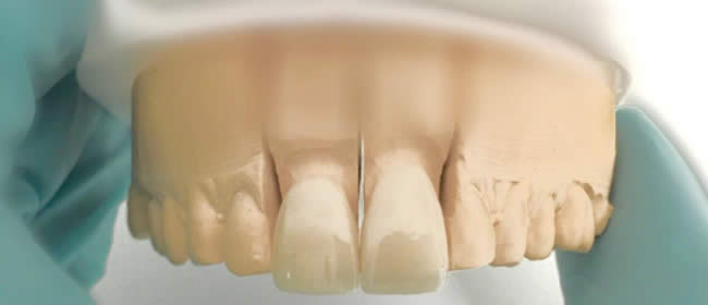 ZahnKronen Bild 5